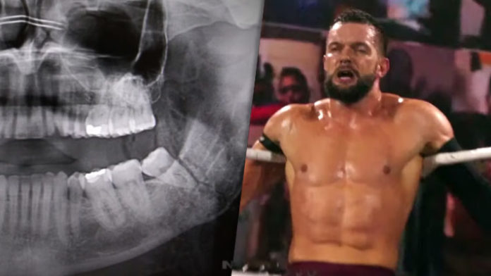 Finn Balor Jaw Fracture