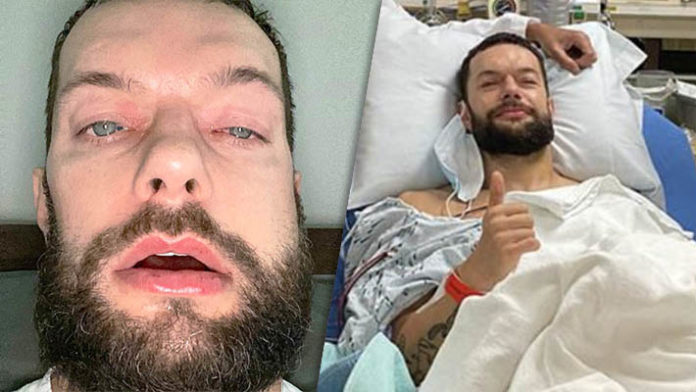 Finn Balor Broken Jaw