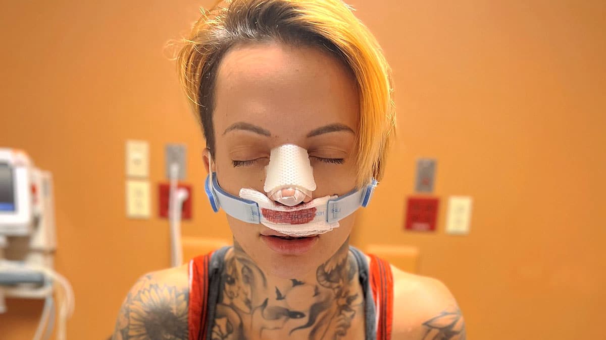 Ruby Soho Nose Surgery